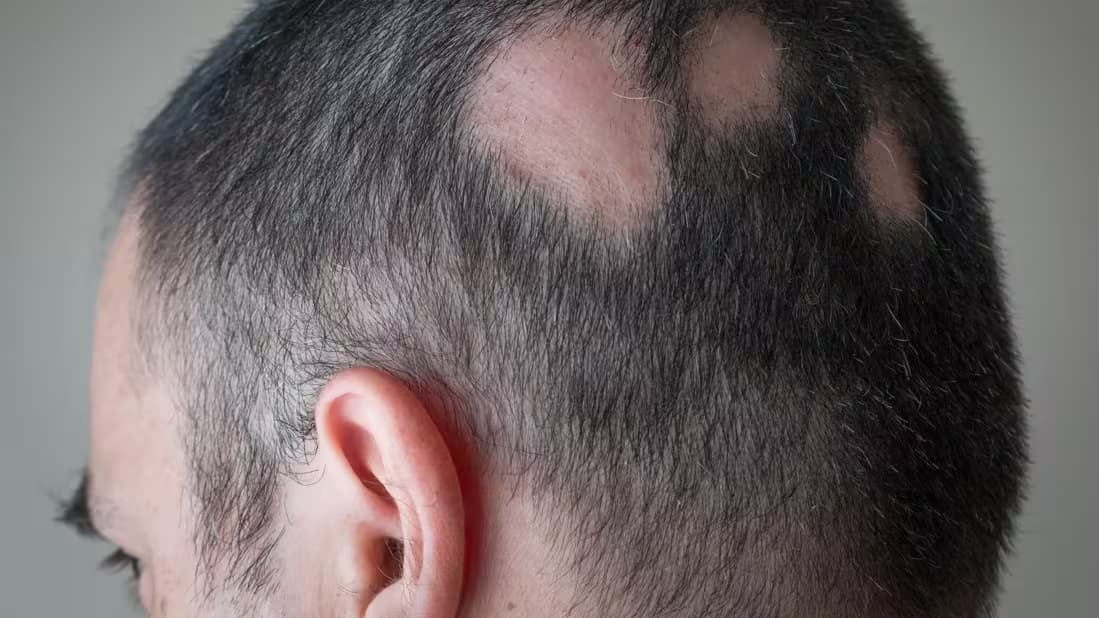 Persoon met alopecia areata met duidelijk afgebakende kale plekken op de behaarde hoofdhuid