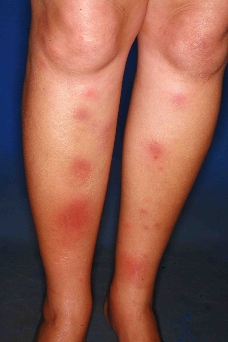 Pijnlijke rode onderhuidse knobbels op beide scheenbenen, kenmerkend voor erythema nodosum.